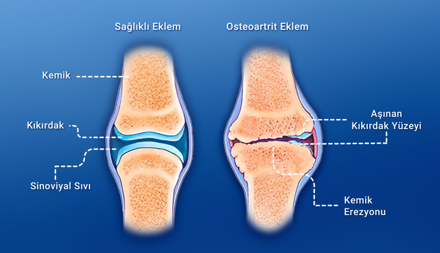 arthritis ne demek