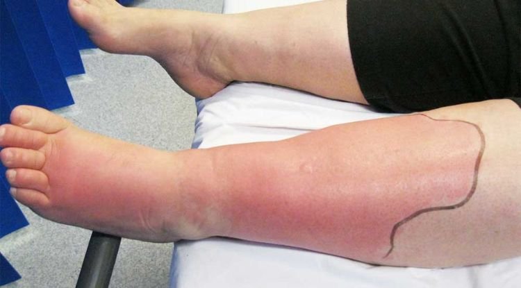 right lower extremity cellulitis icd 10