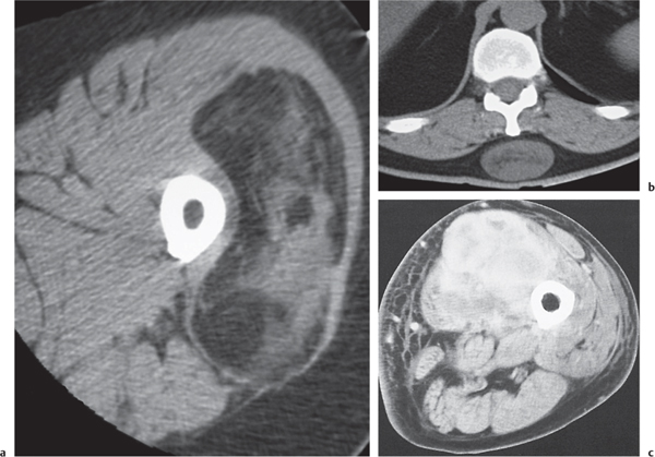 soft tissue density lesion meaning