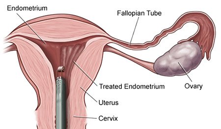 ablación endometrial opiniones