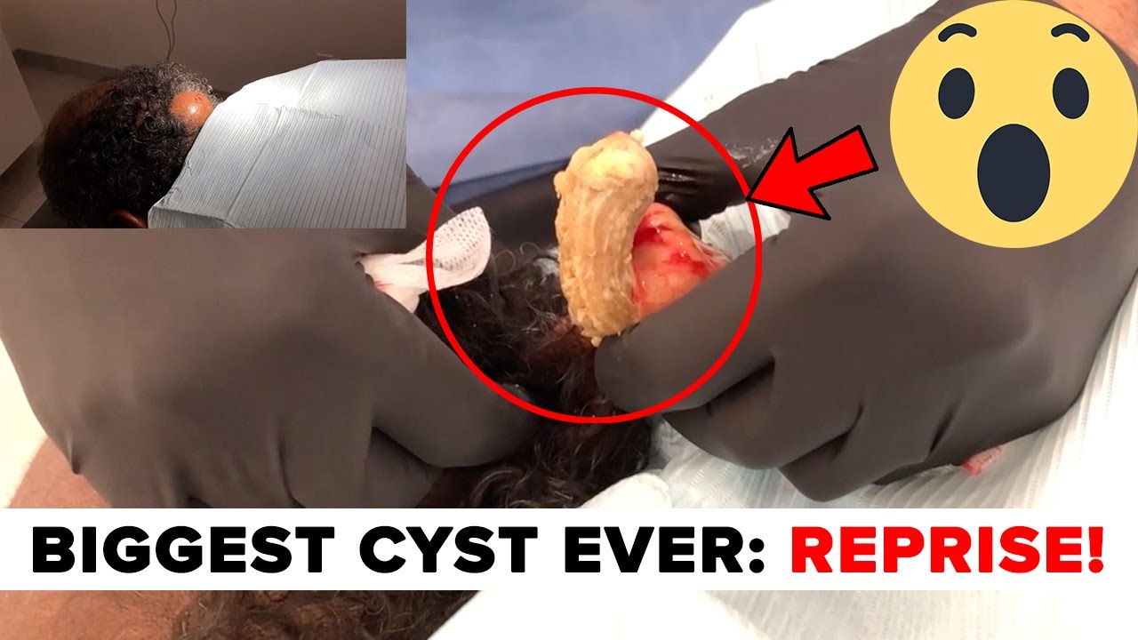 biggest cyst explosion ever seen