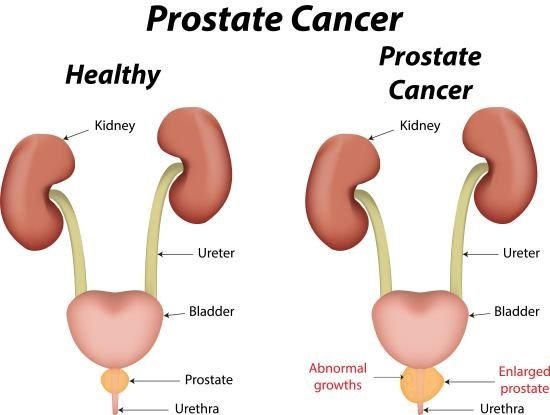 can masturbation cause prostate cancer