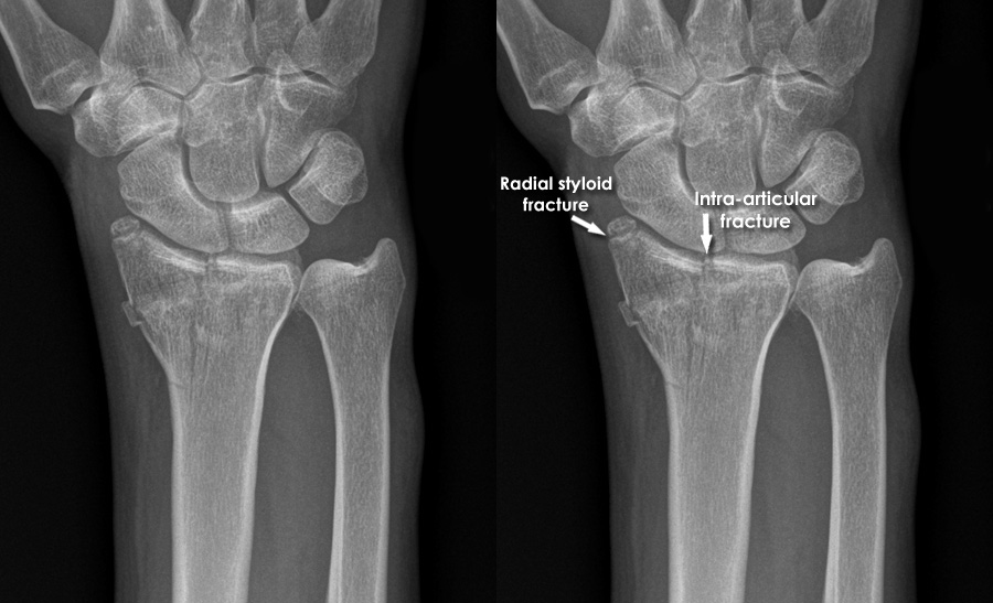 distal radius fracture radiopaedia