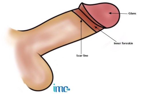 imc circumcision