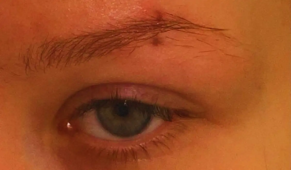 scar from eyebrow piercing