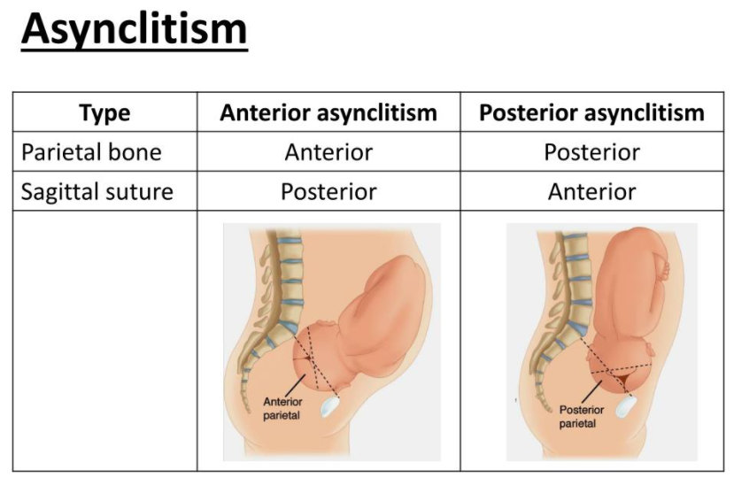 asynclitism meaning