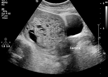 molar pregnancy radiology