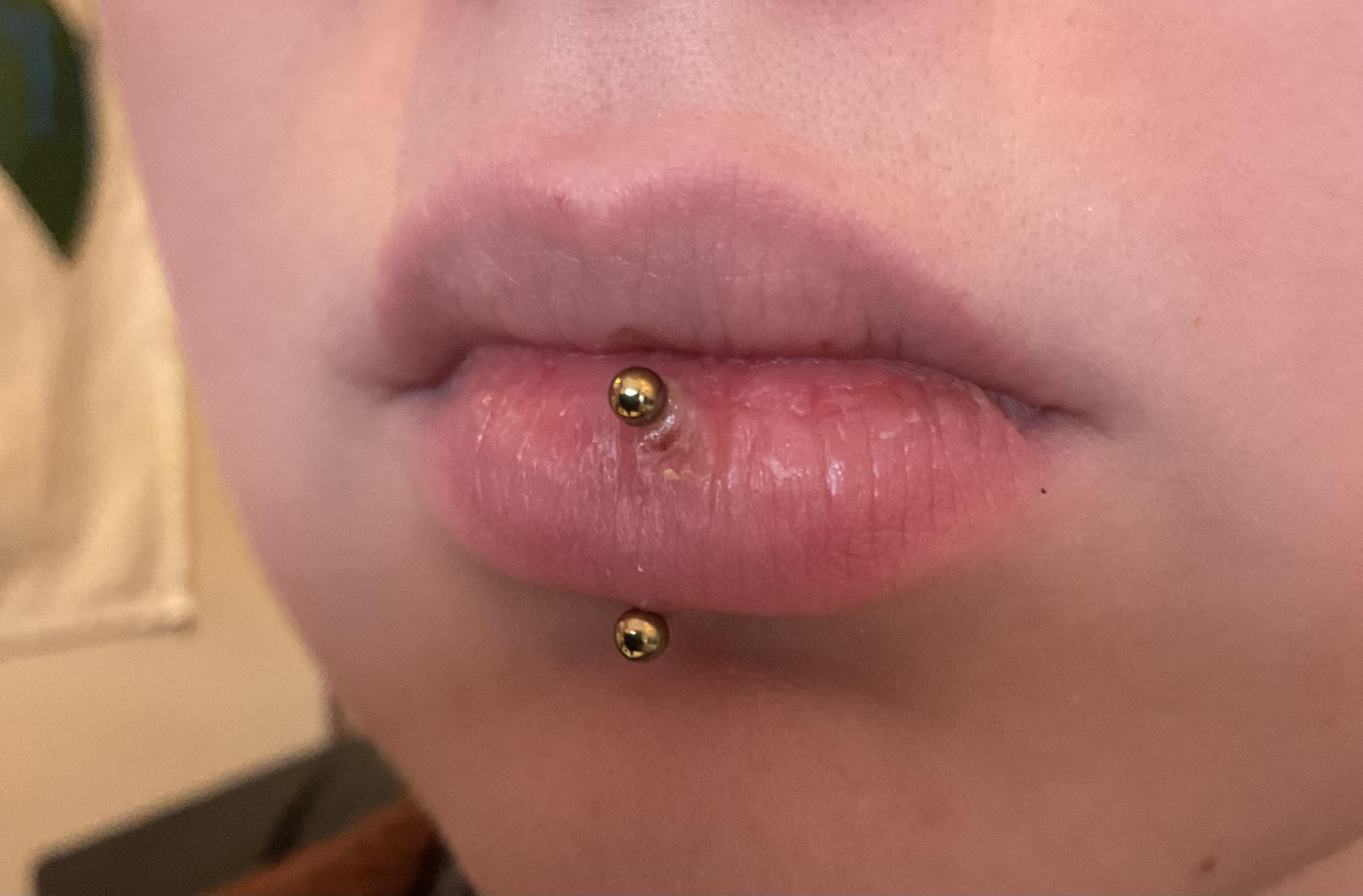 infected vertical labret