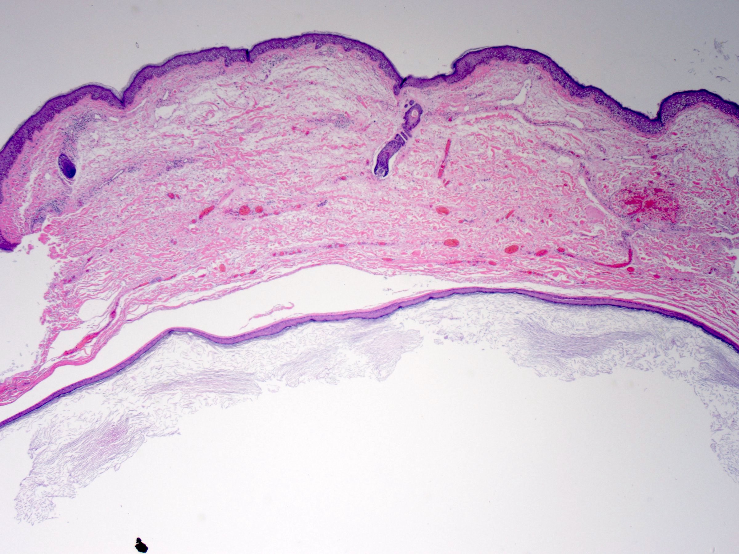 epidermoid cyst pathology outlines