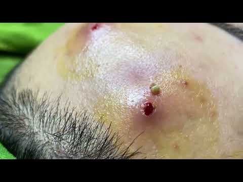 huge blackheads popped