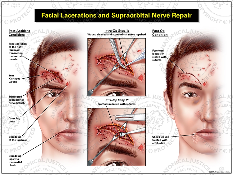 laceration of the face icd 10