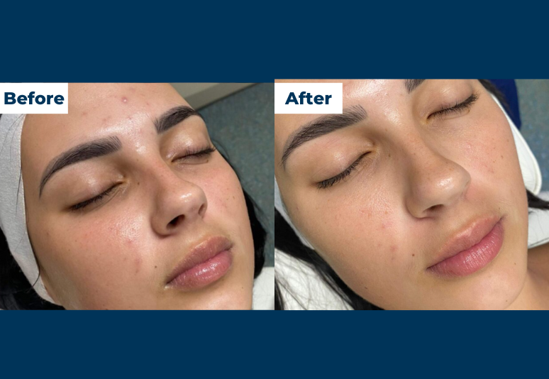 hydrafacial hobart