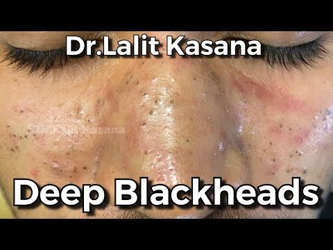 blackhead removal videos