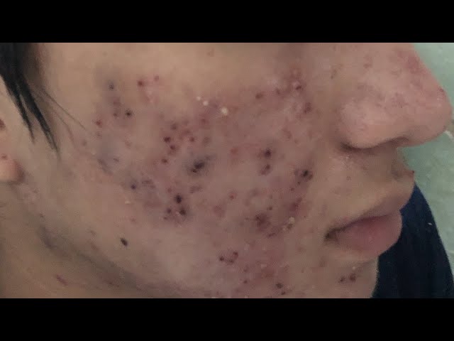 blackheads removal videos 2021