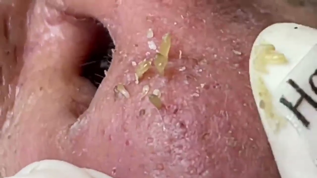 massive blackheads on nose and lips 2022