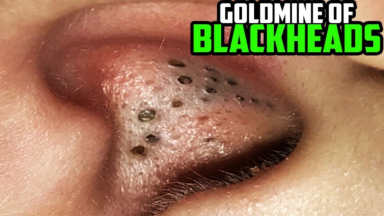 blackheads inside ear