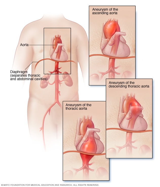 aneurisma mayo clinic