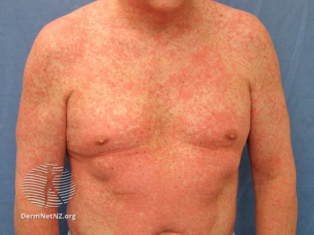 lamotrigine rash photos