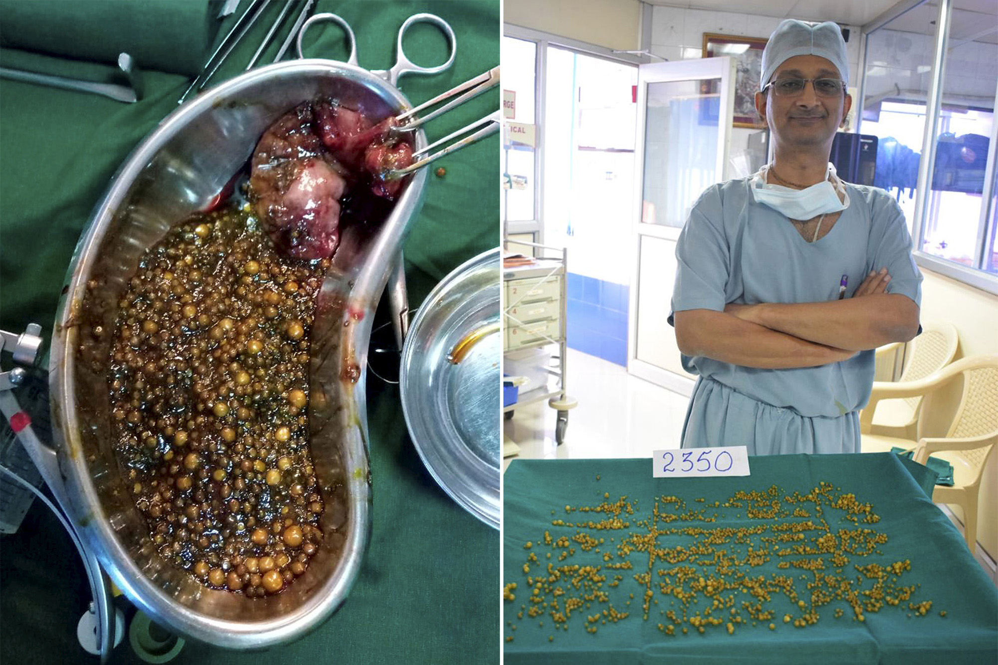 gallstones real pics