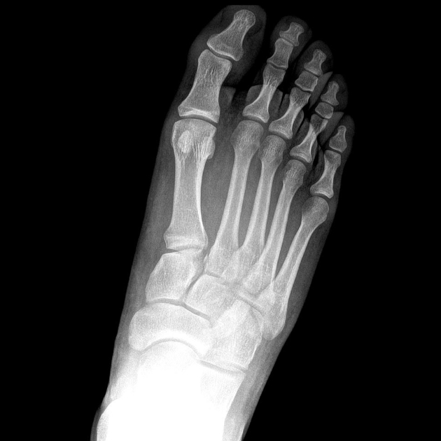 lisfranc fracture radiology