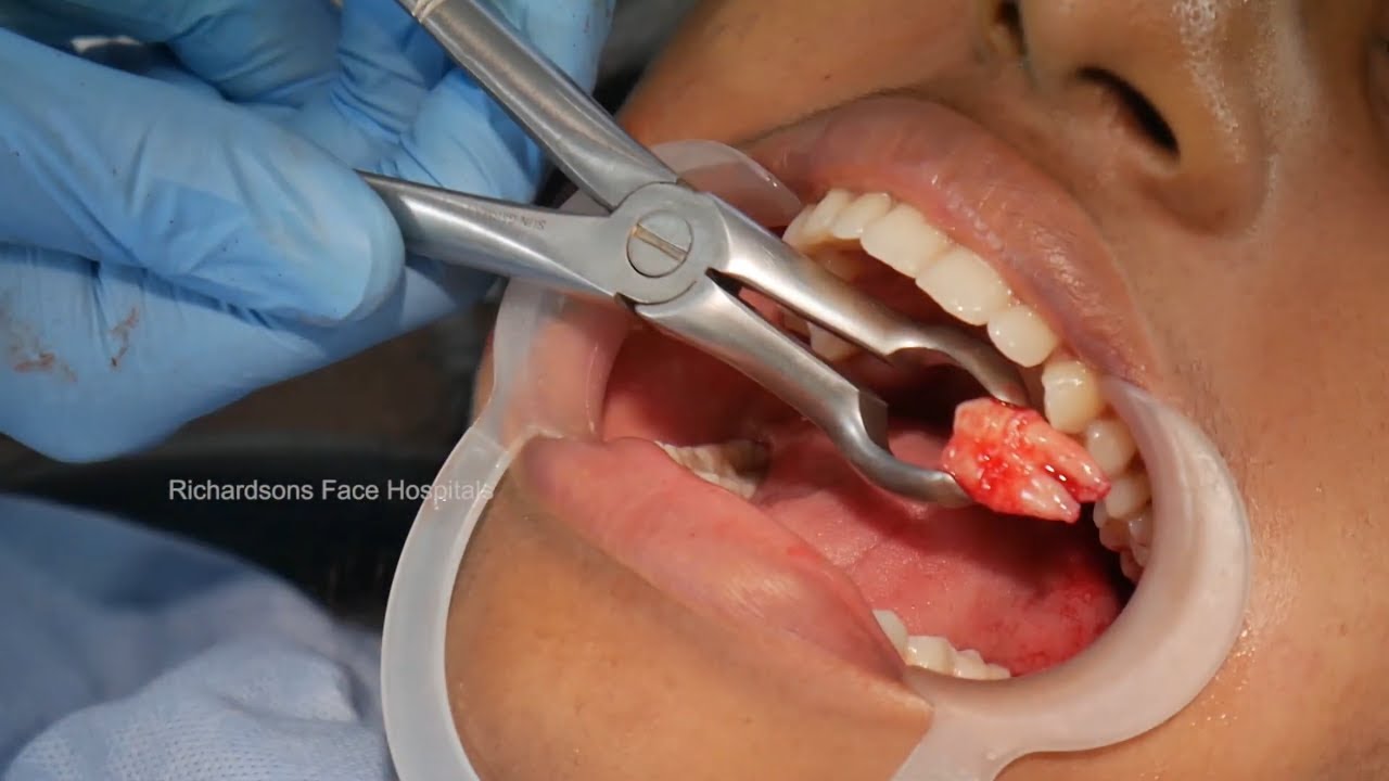 wisdom teeth removal youtube