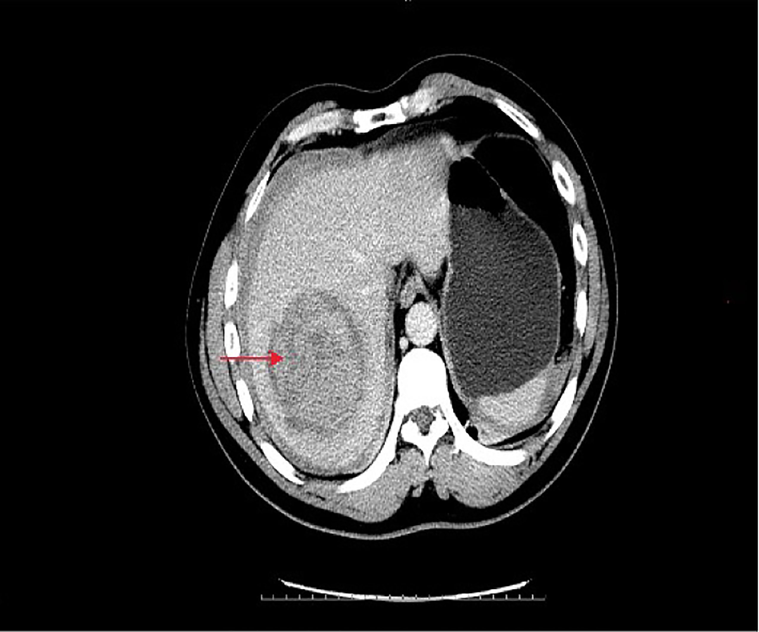 focal nodular hyperplasia liver