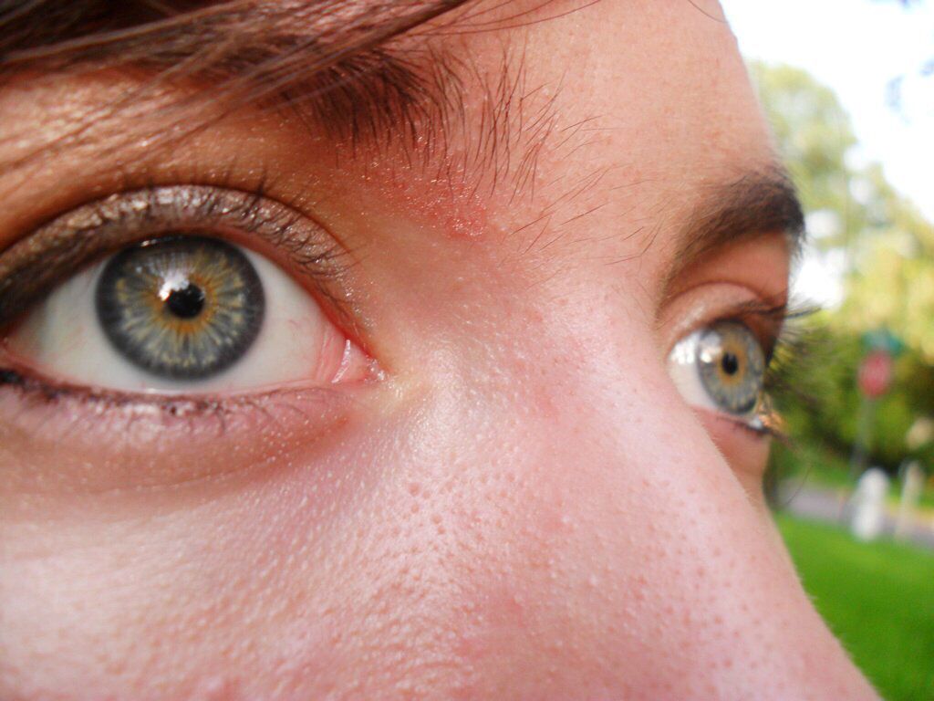 central heterochromia rarity