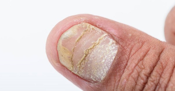 pintar uñas con psoriasis