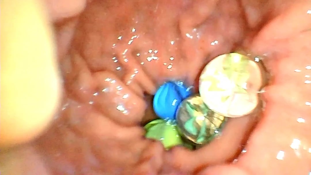 endoscopy vore