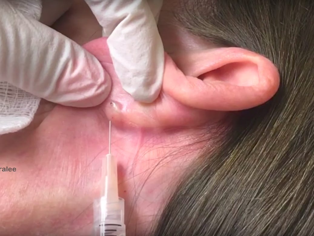 behind ear zit