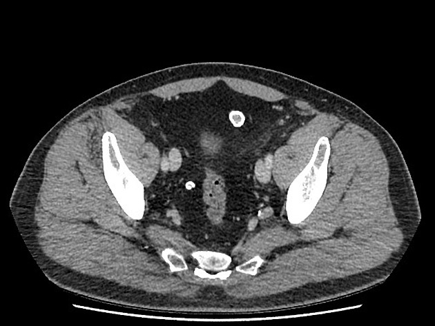 epiploic appendagitis icd 10