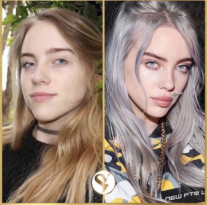 billie eilish plastic surgery