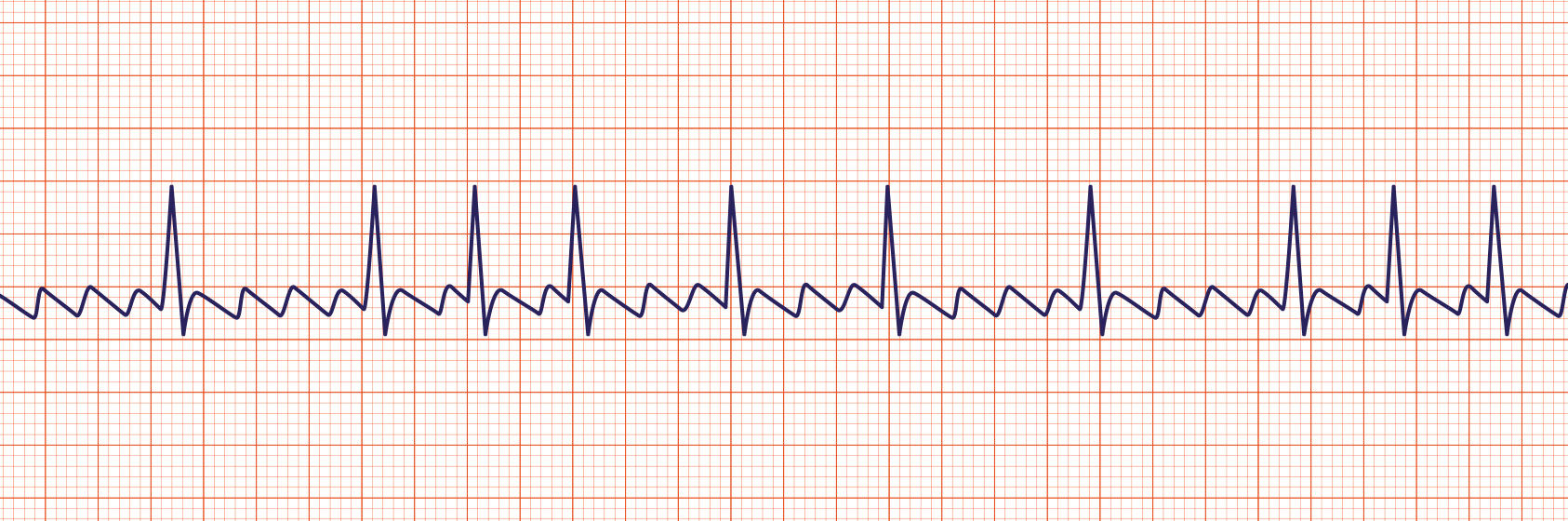 acls ecg rhythms