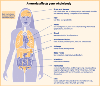 anorexia nervosa