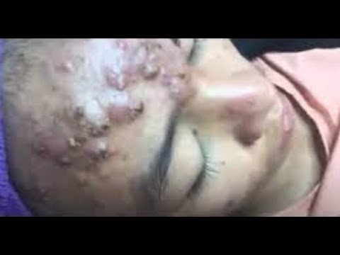 blackhead popping videos 2023