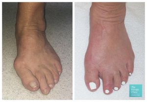 bunion surgery price uk