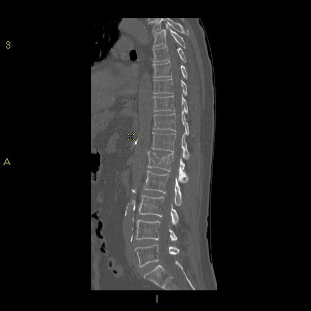 burst fracture radiology