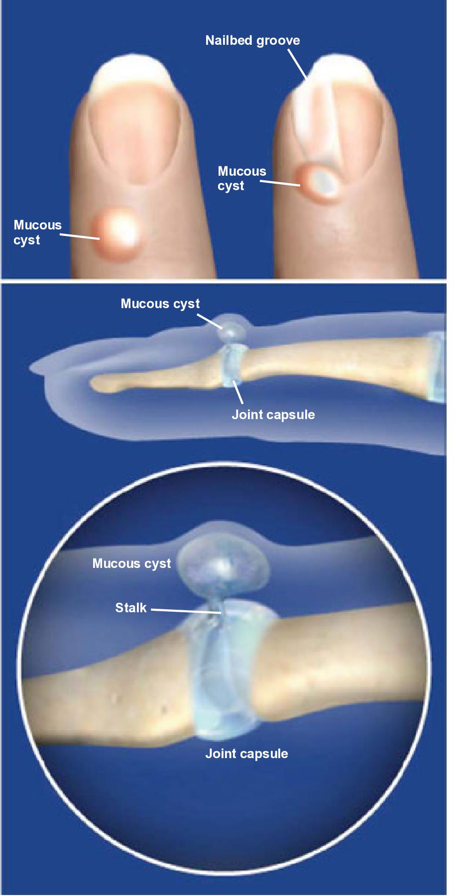 mucous cyst finger icd 10