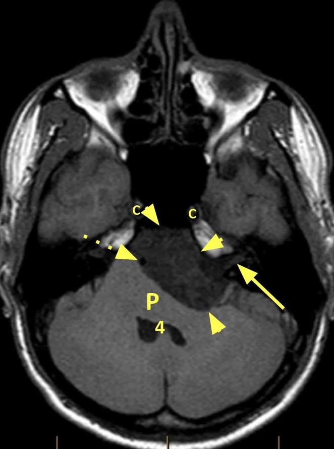 cerebellopontine angle cyst