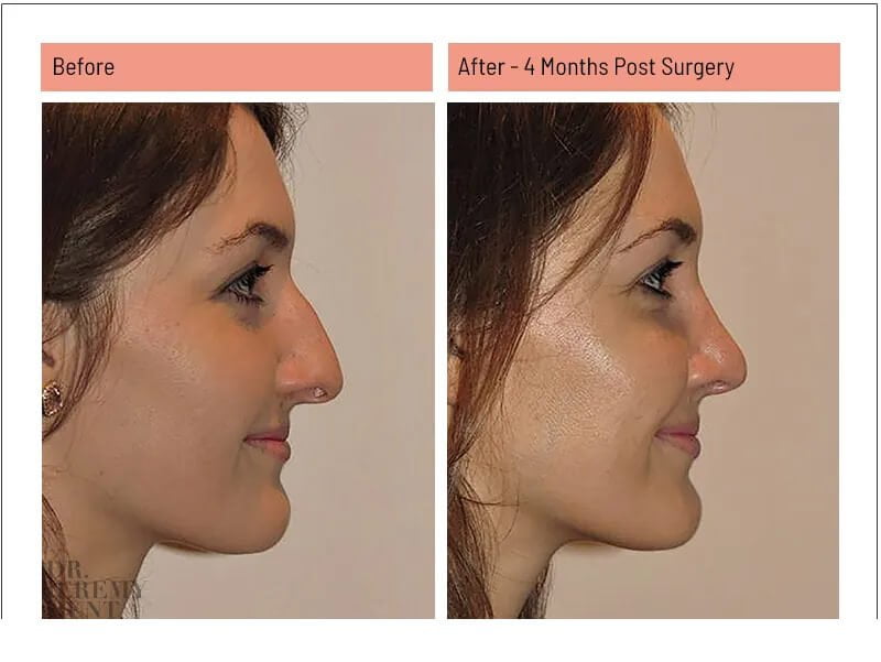 cheap rhinoplasty australia