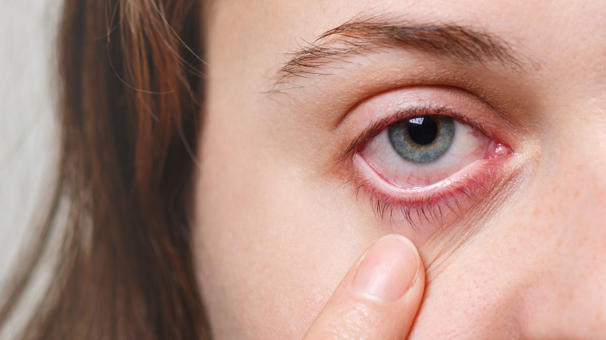 conjuntivitis en aleman