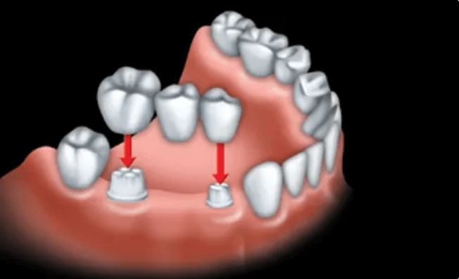 dental bridges consultation maple ridge