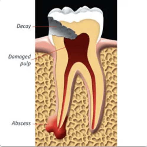 dental root canals services maple ridge