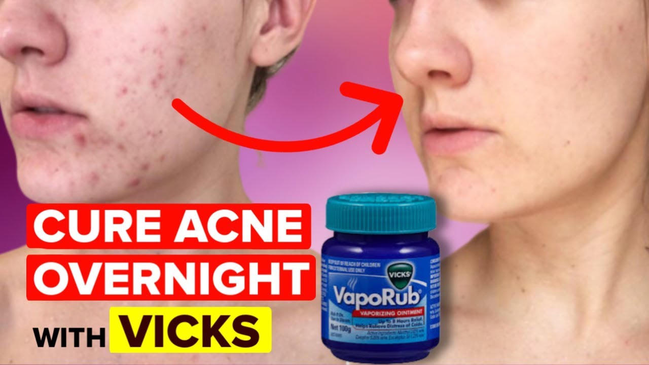 does vicks help pimples