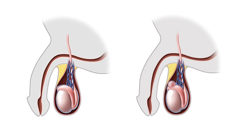 spermatocele wiki