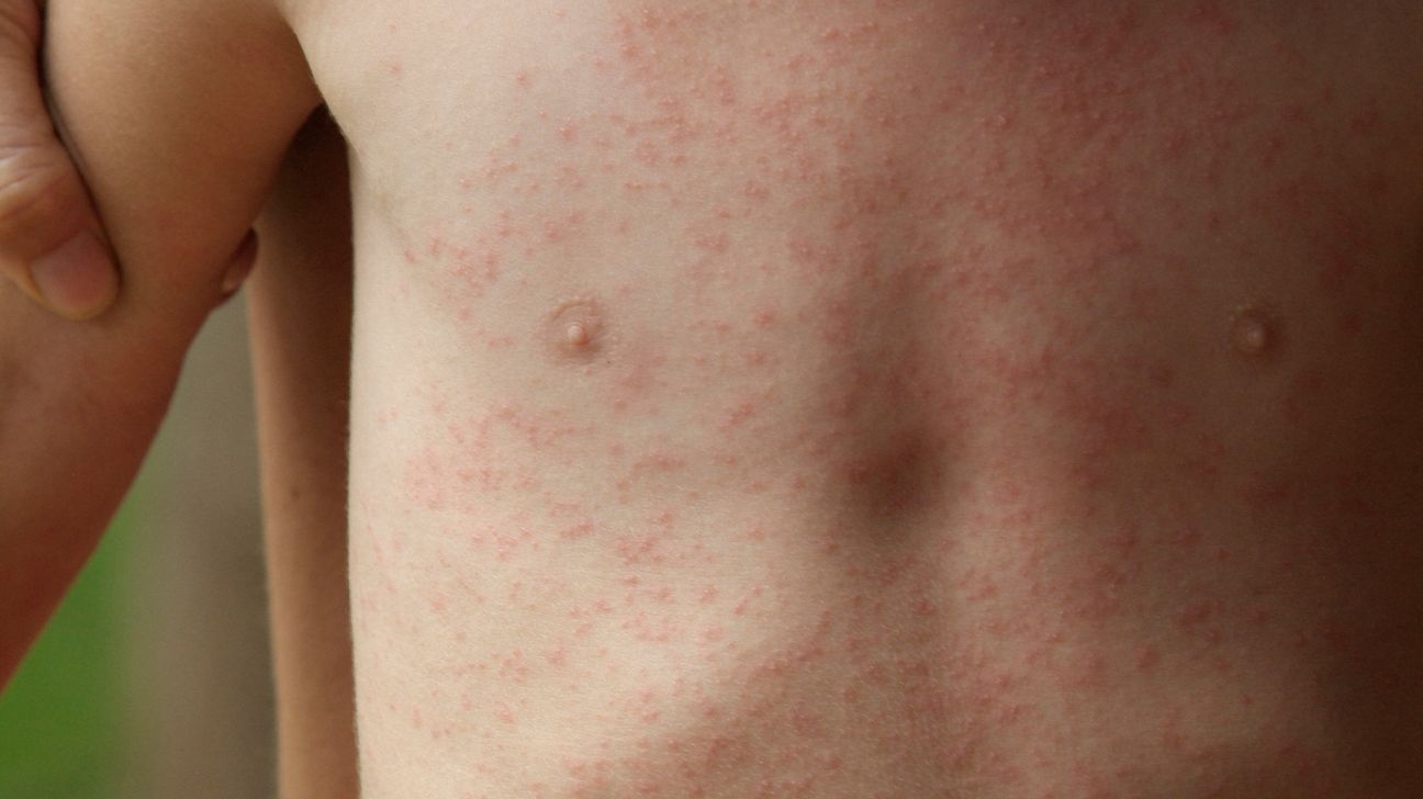 coeliac disease rash photos