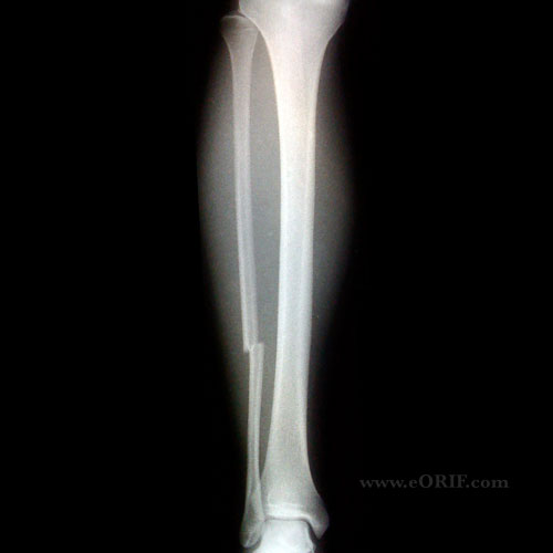 tibia fibula fracture icd 10