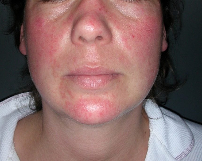 thyroid skin rash pictures face