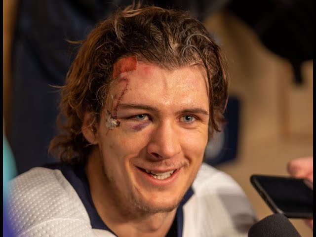 hockey player 75 stitches picture