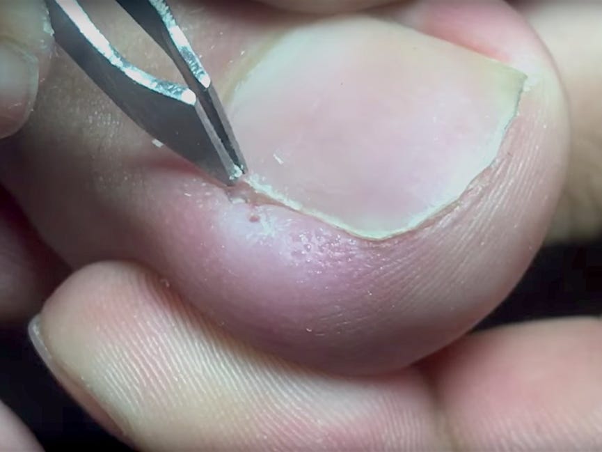 how to remove ingrown toenail youtube